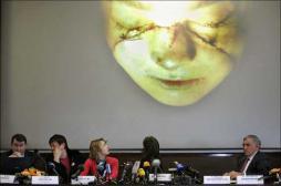 Les visages transplantés vieillissent prématurément