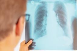 Tuberculose : l'OMS recommande un test de diagnostic rapide 