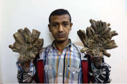 Maladies rares : appel à un nouveau plan national