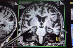 Diagnostic : un dispositif inspiré de la sismologie pour « palper » le cerveau 