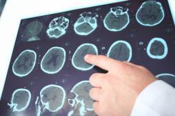 Alzheimer : observer les agrégats de protéines pour affiner le diagnostic