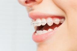 Des résines utilisées dans les appareils dentaires pourraient nuire à la fertilité 