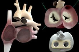 Coeur Carmat : 1ères données cliniques sur les implantations et les décès