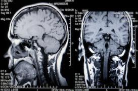 La créatine pourrait retarder la maladie de Huntington 