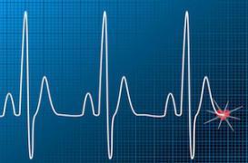 Le sida favorise  l'infarctus