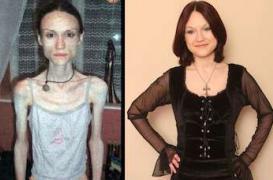 L’anorexie conduit à une perte de matière grise dans le cerveau