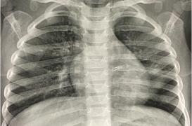 Accident à Noël : une fillette de 14 mois a inhalé une ampoule de guirlande