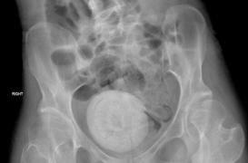 Douleurs au ventre : elle avait un calcul vaginal de la taille d’une orange 