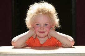 Le syndrome des cheveux incoiffables a une origine génétique