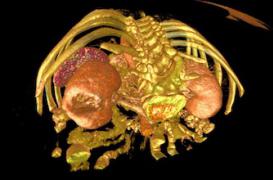 Cancers du rein et de la vessie : le tabac est le principal ennemi