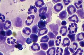 Syndromes myélodysplasiques : les scientifiques près de trouver une solution