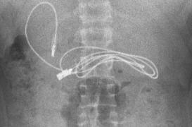 Atteint d’atroces douleurs, cet ado a retrouvé son chargeur… dans son estomac