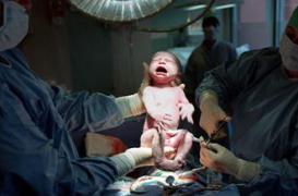 Deux fois plus de césariennes dans les cliniques qu'à l'hôpital