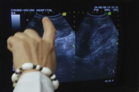 Calculs rénaux : l'opération peut déboucher sur de coûteuses complications 