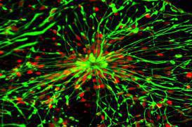 Parkinson : un espoir grâce aux cellules souches