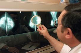 Le dépistage organisé du cancer du sein réduit la mortalité de 21%