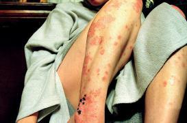 Psoriasis : apprendre à vivre avec la maladie