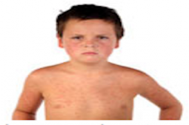 Rougeole : l’appel à la vigilance de l’Invs