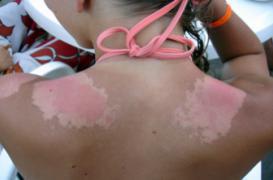 Mélanome : les coups de soleil dans l’enfance font bondir le risque