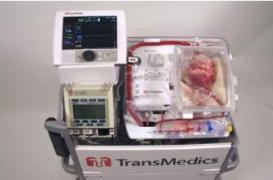 Un cœur transplanté après l'arrêt cardiaque du donneur