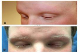 Calvitie : un médicament contre l'arthrite fait repousser poils et cheveux