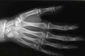 Pour une interdiction des tests d'âge osseux 