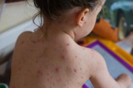 Varicelle : alerte dans 11 régions françaises