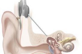 Perte d'audition : vers des implants cochléaires en Wi-Fi