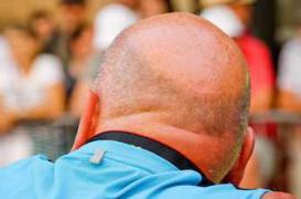 Calvitie : une piste pour la repousse des cheveux découverte accidentellement 