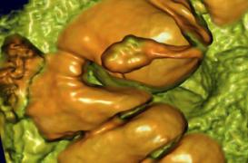 Les médecins recommandent  la coloscopie pour les personnes à risque