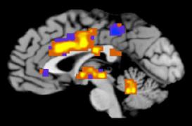 Alzheimer : réveiller les souvenirs avec la stimulation électrique