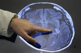 AVC : la double peine pour les femmes 