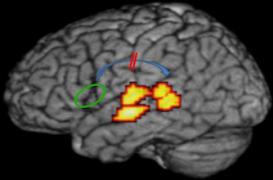 La dyslexie serait liée à un défaut de connexion dans le cerveau