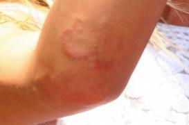 Psoriasis : les malades souffrent des idées reçues