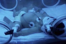 Les prématurés exposés à des formes graves de grippe