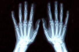 Un Malien expulsé du collège :  le test osseux en cause