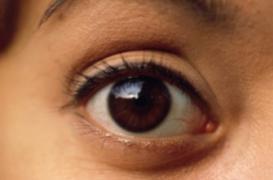 DMLA : un médicament 30 fois moins cher enfin autorisé