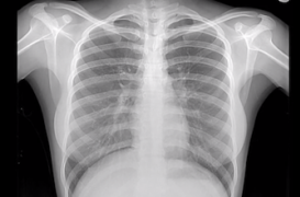 Imagerie : la pénurie de technétium va pénaliser des milliers de patients