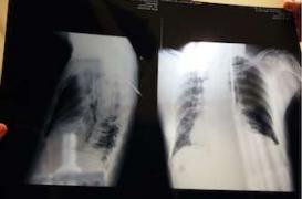 Cancer du poumon : un traitement majeur par immunothérapie