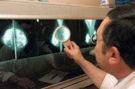 Un traitement contre l’épilepsie efficace dans le cancer du sein