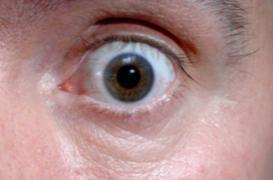 Oeil bionique : deux patients implantés à Bordeaux