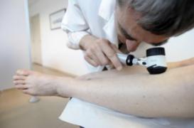 Mélanome : les hommes célibataires sont diagnostiqués plus tard