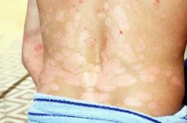 La sédentarité en cause dans la progression du psoriasis