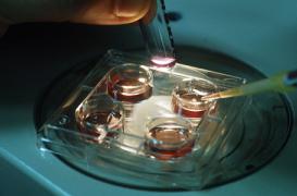 FIV : la grossesse multiple accroit le risque de cancer du sein