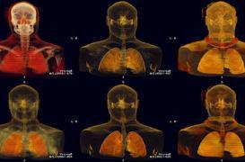 Cancer bronchique: tripler le nombre de guérisons 