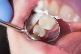 Bientôt un émail biologique pour traiter les caries ?
