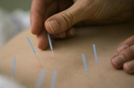 Cancer du sein : l'acupuncture réduit les bouffées de chaleur 