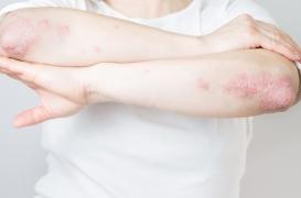 Psoriasis : la gravité de la maladie est liée à une protéine 