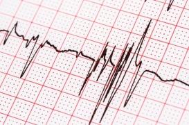 Frédéric, 65 ans, opéré d'une fibrillation atriale : 