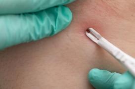 Tiques : quels sont les signes de la maladie de Lyme ?